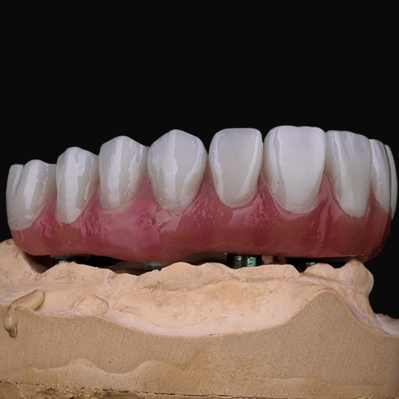 Zirconia full arch offers strong, durable, natural-looking restoration with stable implant support